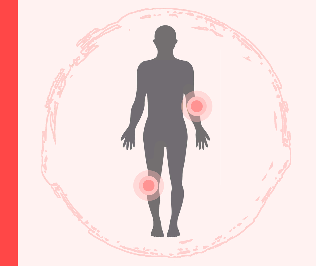 Grafik einer Person mit roten Markierungen am rechten Knie und linken Ellenbogen, die die Schuppenflechte darstellen soll.