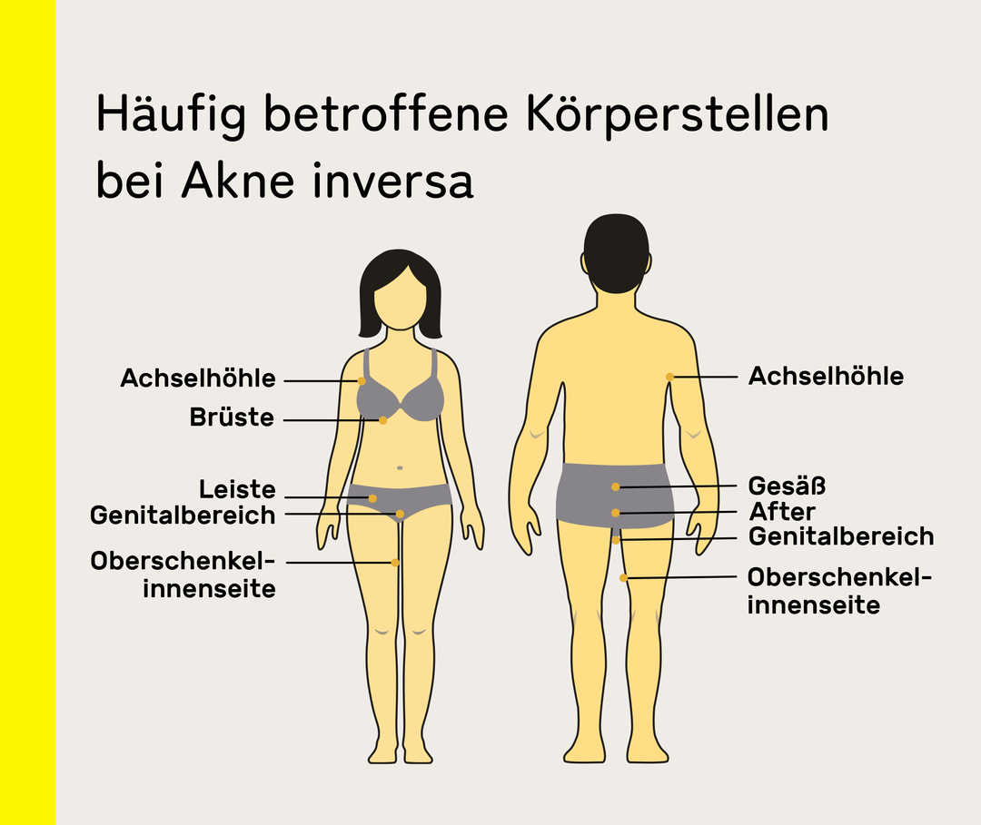 Häufig betroffene Körperstellen bei Akne inversa.