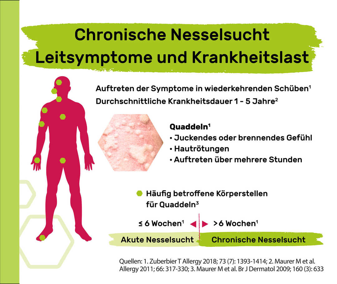 Die Illustration beschreibt das Leitsymptom Quaddeln bei Nesselsucht.
