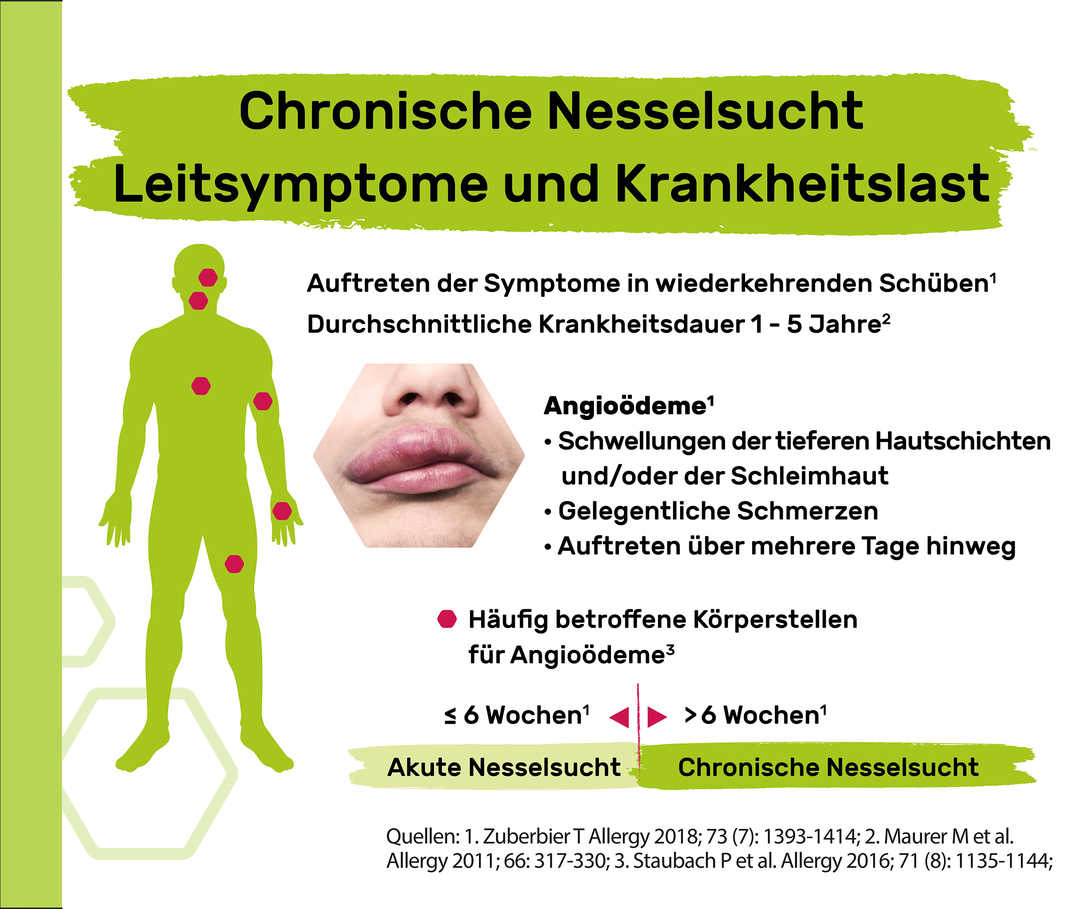 Die Illustration beschreibt das Leitsymptom Angioödeme bei Nesselsucht.