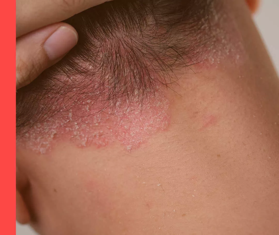 Hautschuppen am Haaransatz oberhalb des Halses.