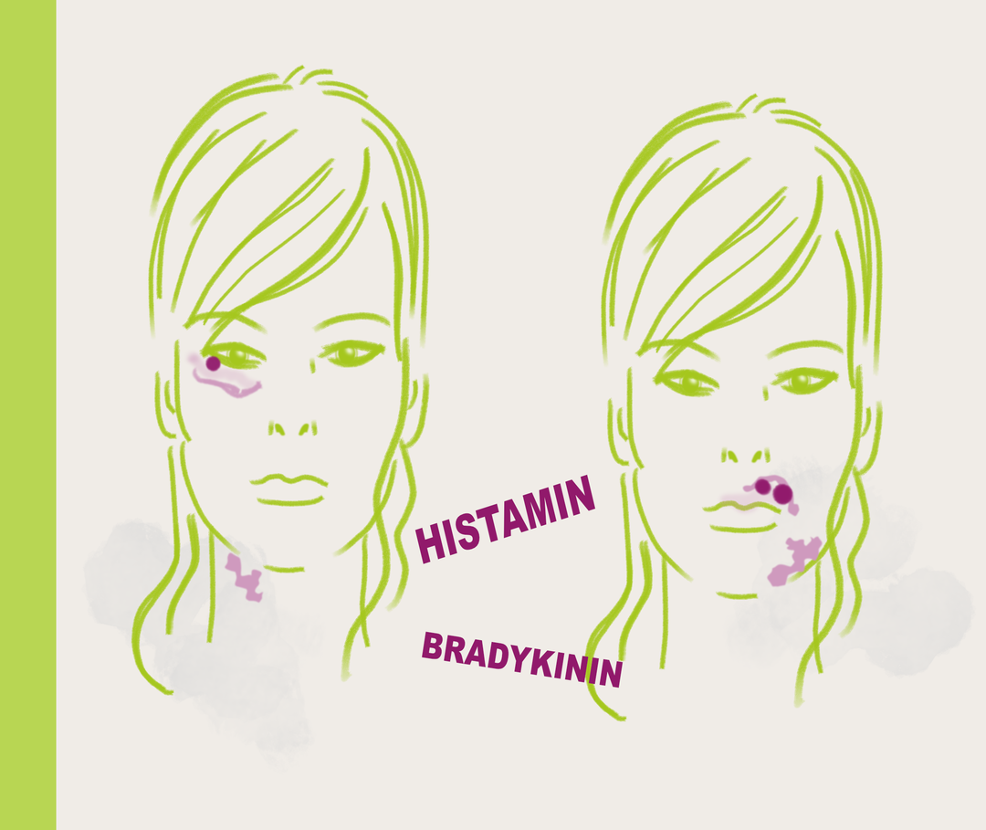 Illustration mit zweimal demselben Gesicht einer Frau. Links hat das Gesicht Rötungen über und unter dem Auge und am Hals. Bei der rechten Abbildung an den Lippen und am Kinn.