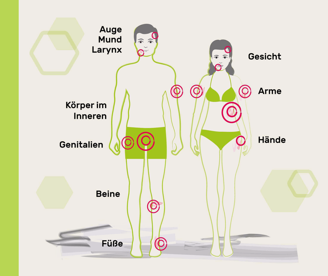 Illustration, in der an einer Frau und an einem Mann die Körperteile markiert sind, die bei Nesselsucht vorrangig von Angioödemen betroffen sind. Diese sind: Auge, Mund, Larynx, Körper im Inneren, Genitalien, Beine, Füße, Gesicht, Arme, Hände.