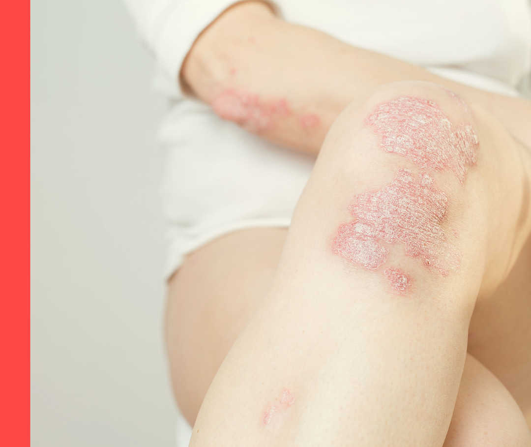 Auf Knie und Ellenbogen einer Person sind schuppige Hautsymptome zu sehen. 