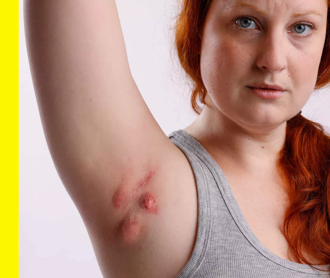 Eine Frau rötliche Hautsymptome in ihrer Achselhöhle.