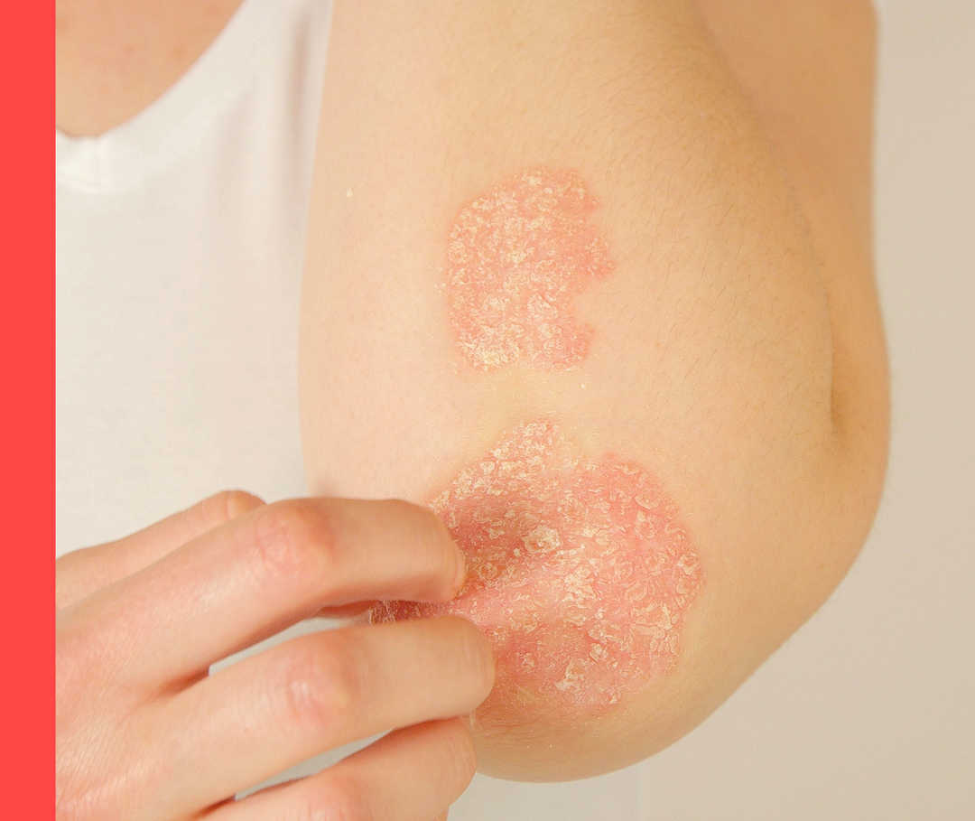 Psoriasis Schuppungen am Ellenbogen.