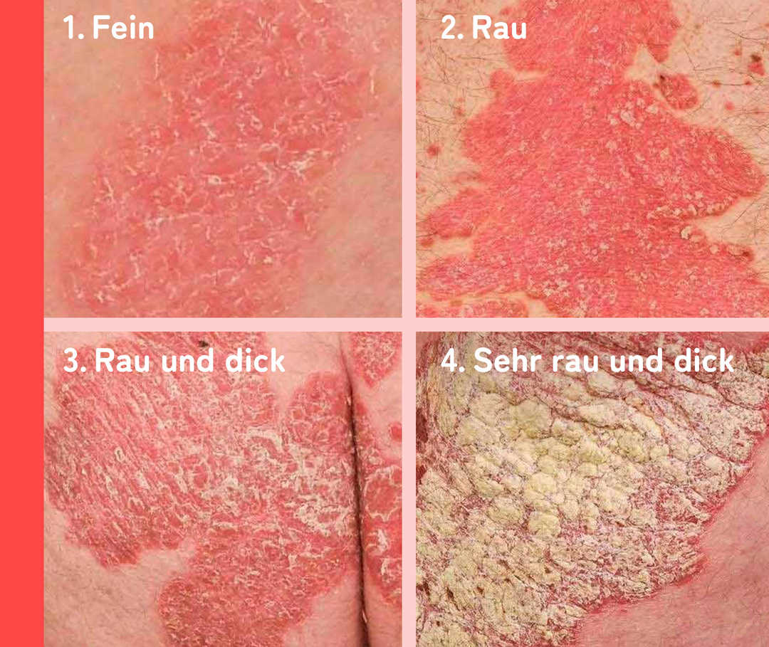 Schuppenflechte-Symptome einstufen.