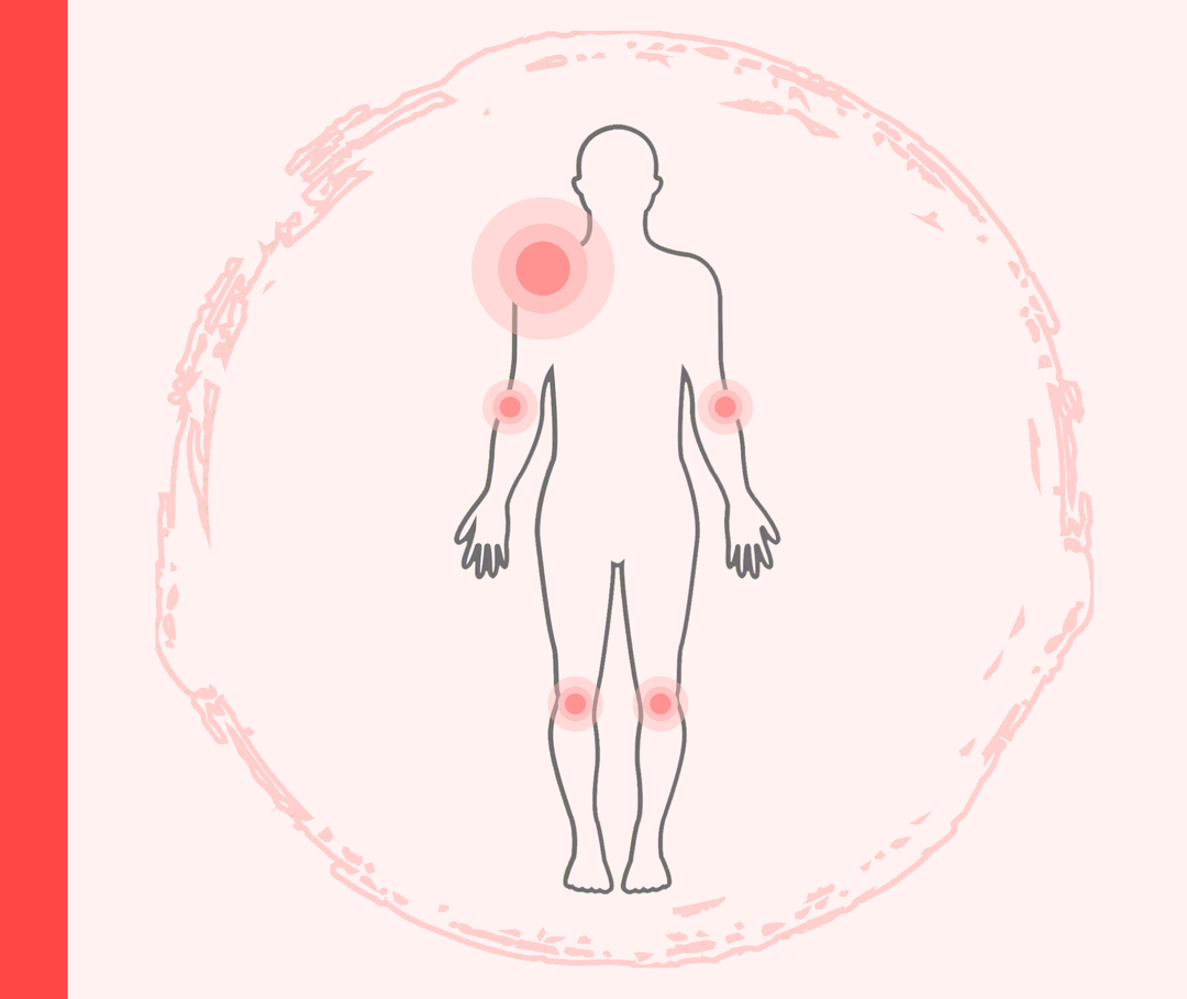Grafik eines Menschen mit roten Markierungen an häufigen Stellen der Psoriasis vulgaris. 