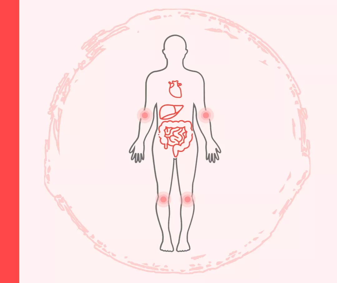 Psoriasis: Begleiterkrankungen Umriss einer Person mit roten Markierungen im Bereich der Ellenbogen- und Kniegelenke sowie Darstellung des Herzens, der Leber und des Darms.