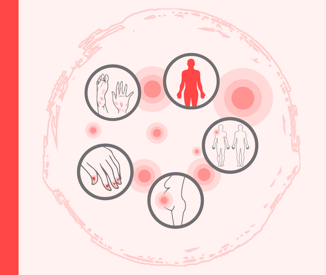 Fünf Icons, die die fünf Unterformen der Psoriasis pustulosa darstellen sollen. 