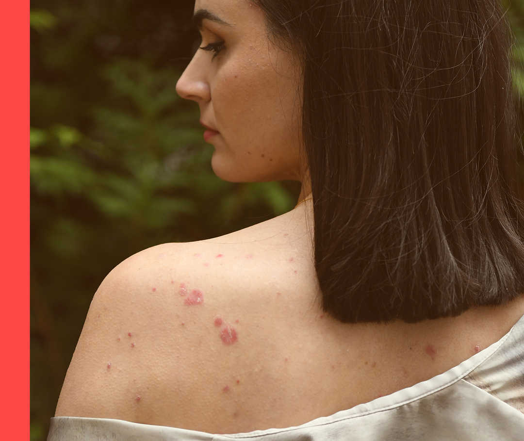 Sine steht mit dem Rücken zur Kamera und schaut in die Richtung ihrer entblößten Schulter. Die Haut weist rote Stellen auf.