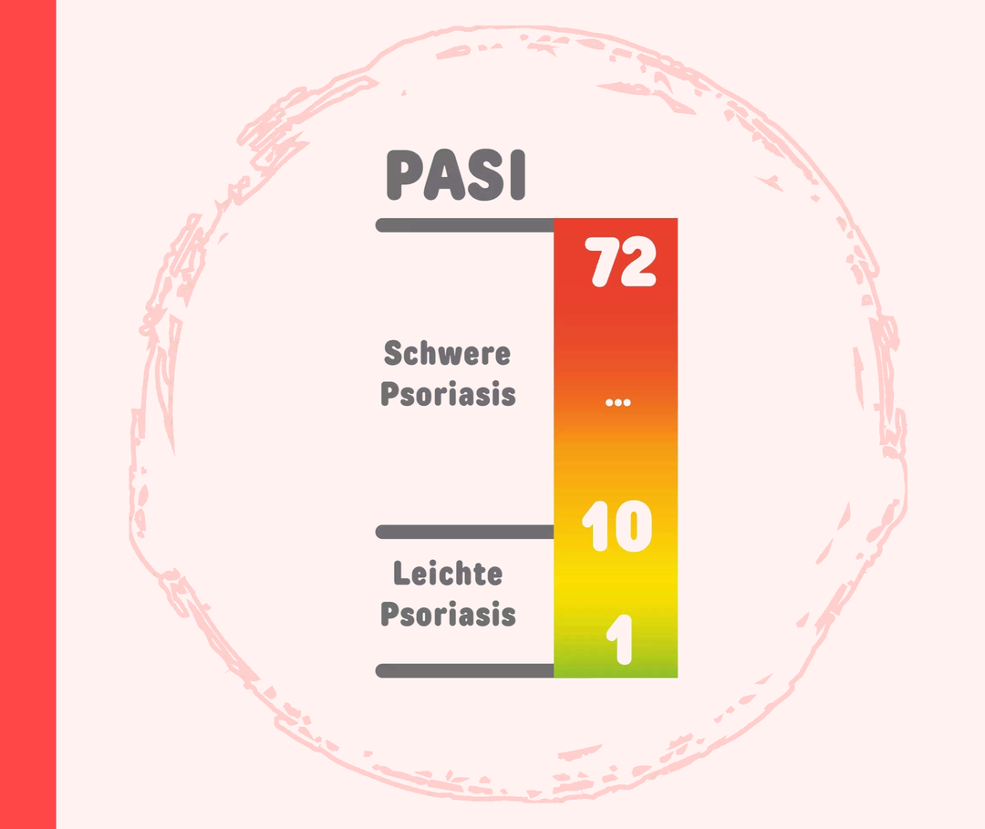 Schweregradbestimmung: PASI Infografik mit einem Maßstab, der den Psoriasis Area and Severity Index (PASI) darstellt. Zu sehen ist die Unterteilung in leichte Psoriasis von eins bis zehn und in schwere Psoriasis von zehn bis 72.
