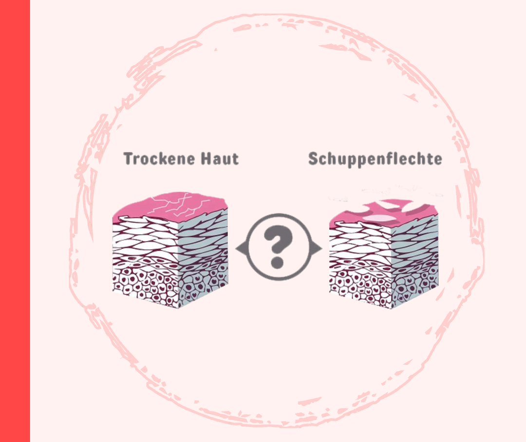 Grafiken mit zwei Darstellungen der Hautschichten. Über der linken Darstellung steht „Trockene Haut“, über der rechten „Schuppenflechte“. In der Mitte befindet sich ein Fragezeichen. 