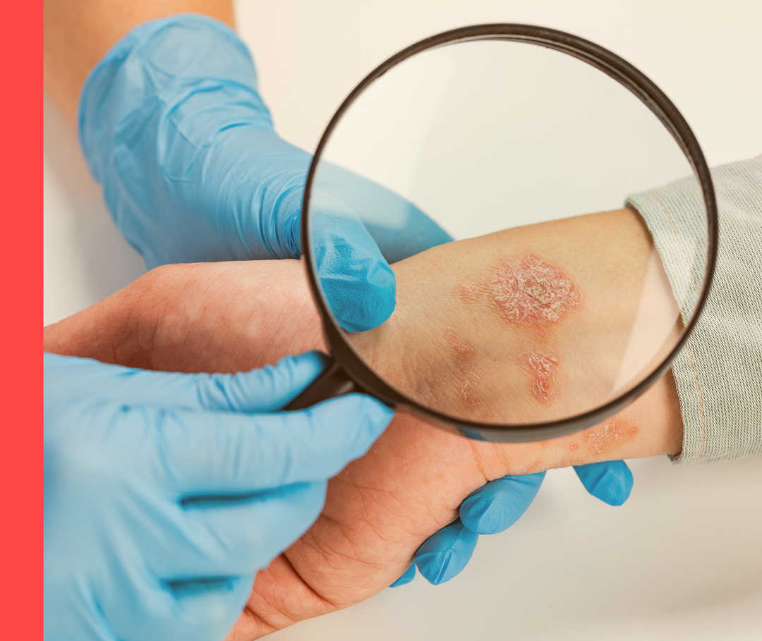 Nahaufnahme von zwei Händen in Handschuhen, die einen geröteten, schuppigen Unterarm untersuchen