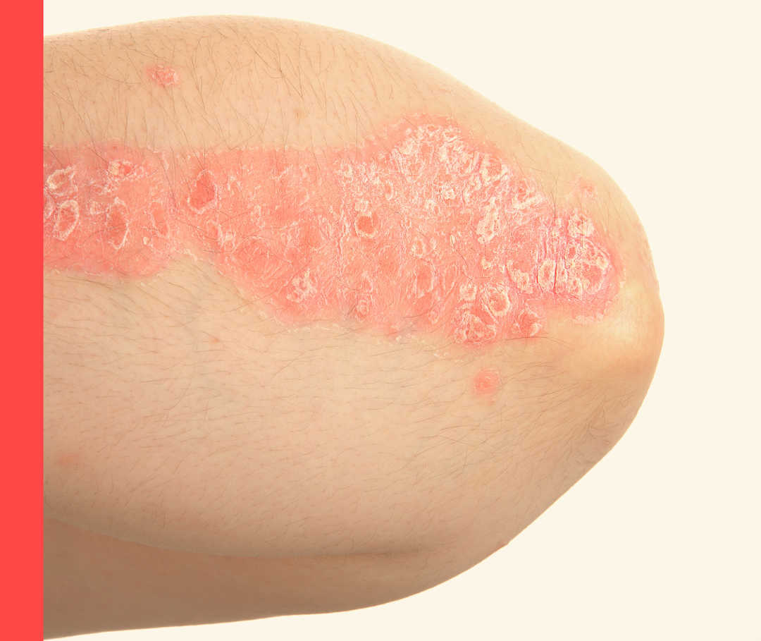 Ein Ellenbogen mit geröteten, schuppigen Psoriasis-Plaques.