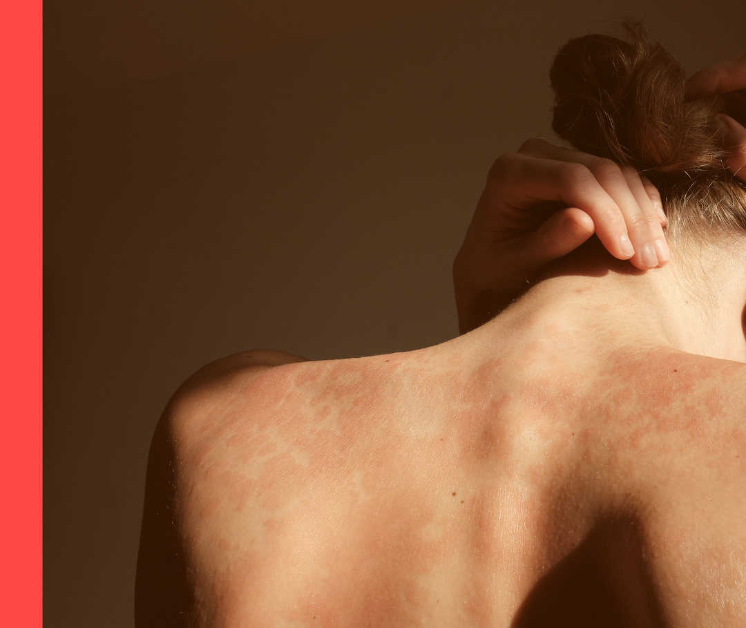 Nahaufnahme einer Person mit unbekleidetem Rücken, auf dem rote Flecken zu sehen sind. 